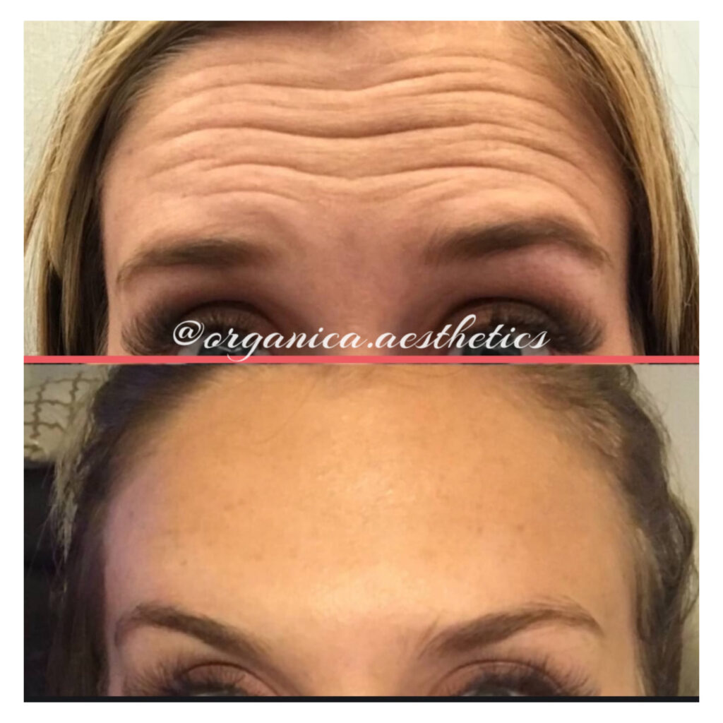 Before-and-after forehead treatment results from Organica Aesthetics in Round Rock