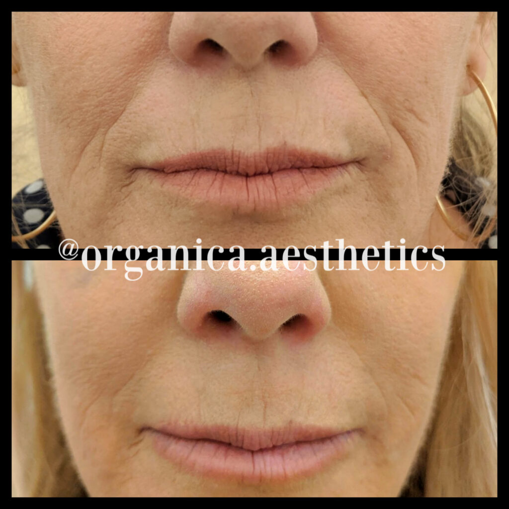 Before-and-after smile line results from Organica Aesthetics in Round Rock